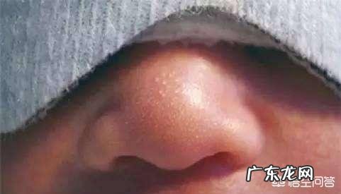 出生的婴儿脸上有小白点是怎么回事?