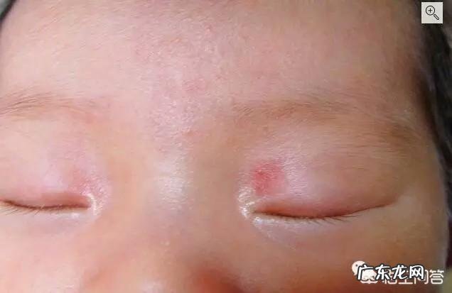 出生的婴儿脸上有小白点是怎么回事?