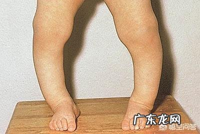 儿童维生素D缺乏会出现什么症状?