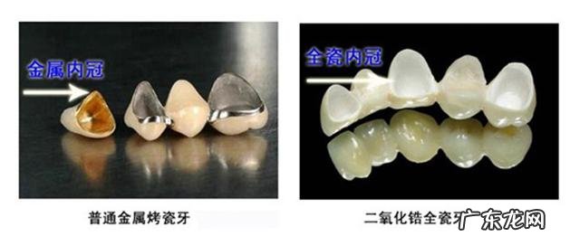 烤瓷牙有哪些危害?