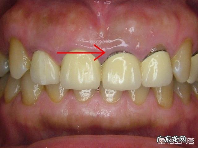 烤瓷牙有哪些危害?