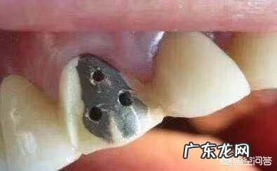 烤瓷牙有哪些危害?