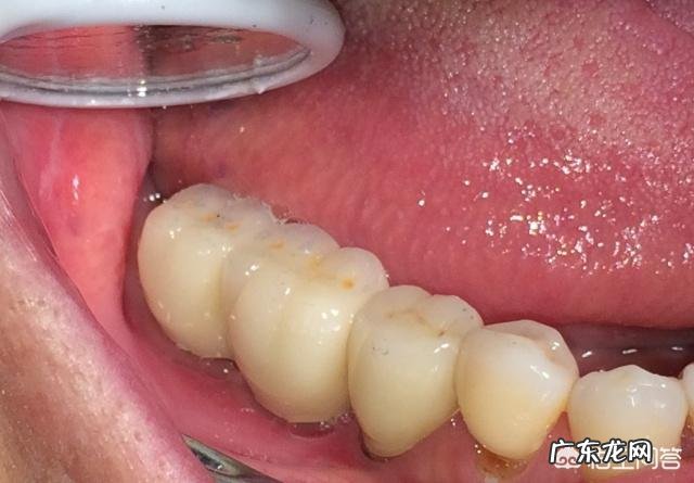 烤瓷牙有哪些危害?