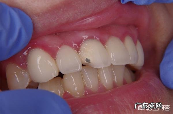 烤瓷牙有哪些危害?