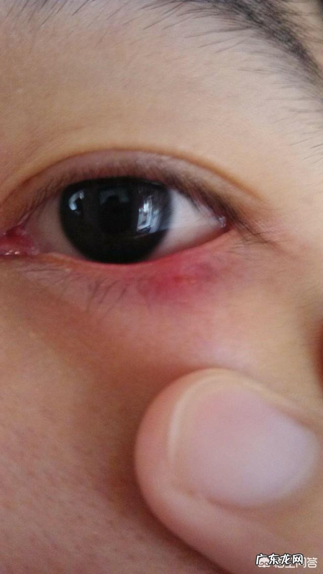 长针眼了,很疼,怎么办?