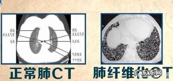 肺部纤维化是一种什么病?