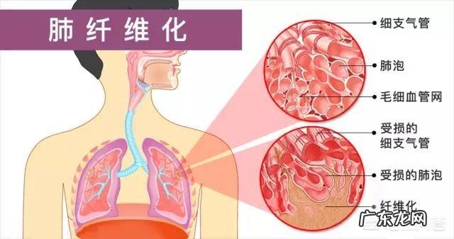 肺部纤维化是一种什么病?