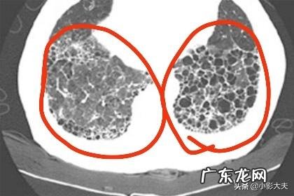 肺部纤维化是一种什么病?