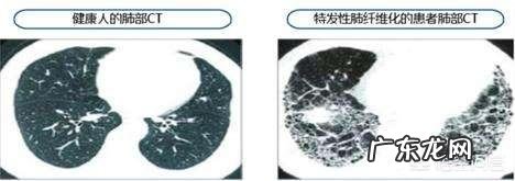 肺部纤维化是一种什么病?