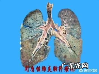 肺部纤维化是一种什么病?