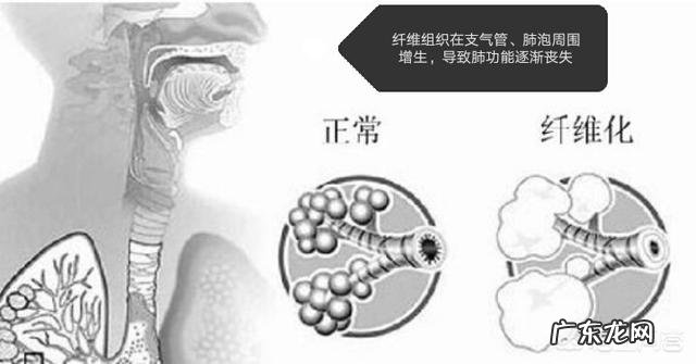 肺部纤维化是一种什么病?