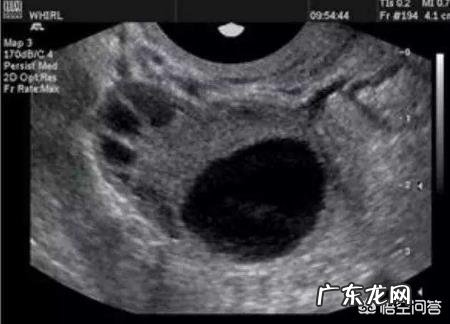 姨妈正常周期短,量不多,不排卵怎么办?