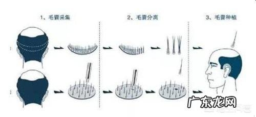秃顶会遗传吗?有哪些科学依据?