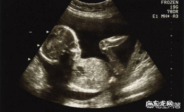 孕期B超对胎儿有危害?如何合理安排B超检查?