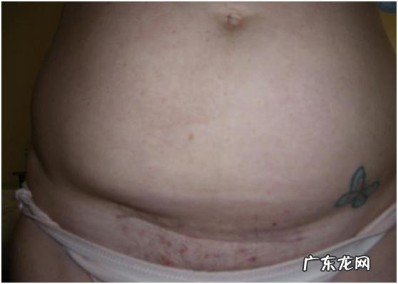剖宫产正常疤痕是怎样的,会不会很厚?