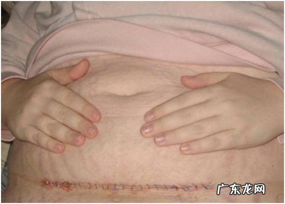 剖宫产正常疤痕是怎样的,会不会很厚?