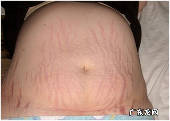 剖宫产正常疤痕是怎样的,会不会很厚?