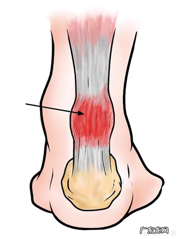 隐隐感觉足跟痛,时有时无,是怎么回事?