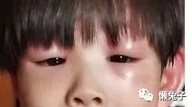 巧用蒲公英治孩子眼睛肿胀医案