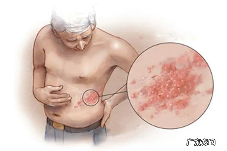 真正艾滋病脸部图片 艾滋病一开始的皮肤图 皮肤病