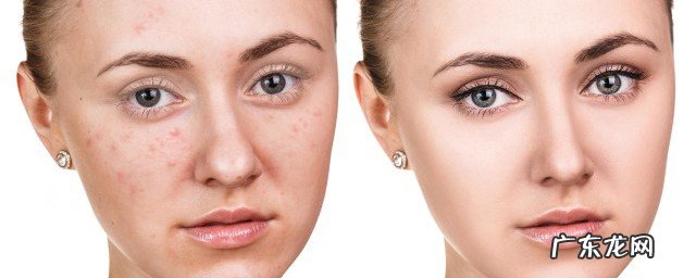 脑门和下巴长痘痘怎么调理