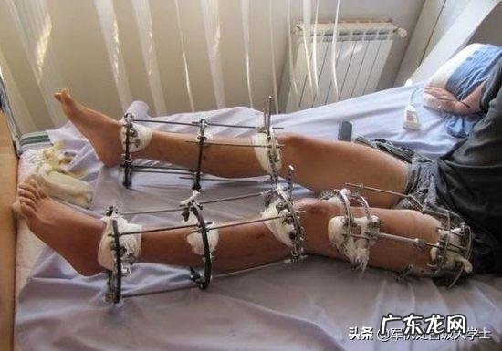 想增高，断骨增高靠谱吗？