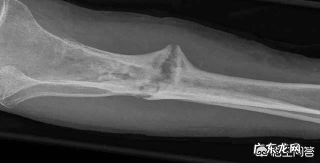 想增高,断骨增高靠谱吗?