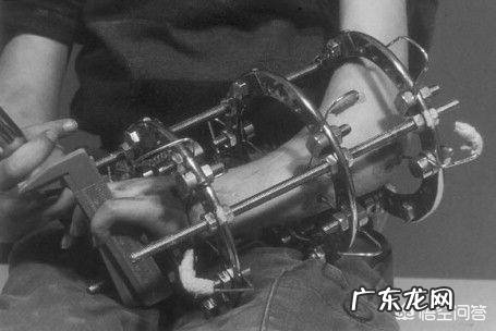 想增高,断骨增高靠谱吗?