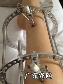 想增高,断骨增高靠谱吗?