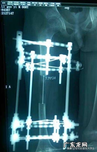 想增高，断骨增高靠谱吗？