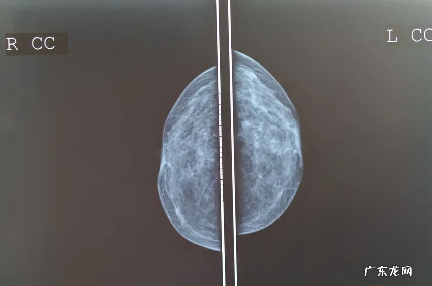 这些竟都是乳腺癌征兆北大医生教你怎样尽早发现乳腺癌 乳腺癌的早期症状图片大全