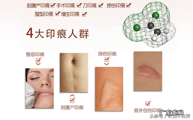 疤痕增生刚开始出现怎么消除 疤痕如何消除