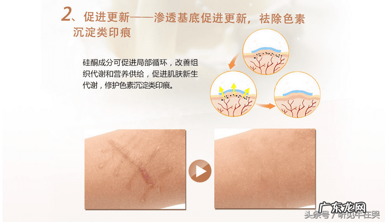 疤痕增生刚开始出现怎么消除 疤痕如何消除