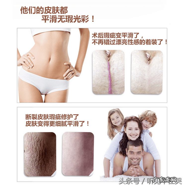 疤痕增生刚开始出现怎么消除 疤痕如何消除