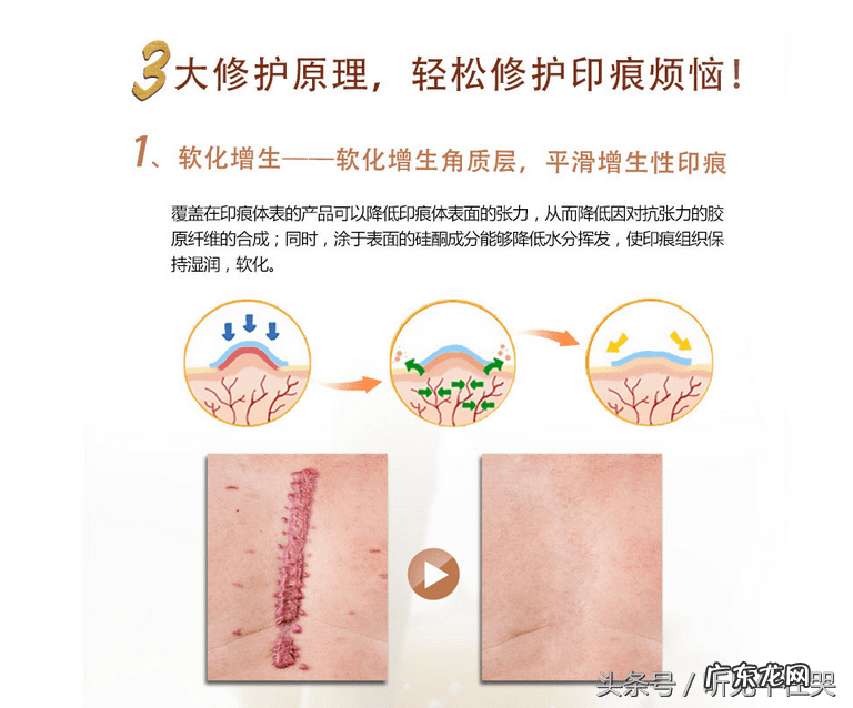 疤痕增生刚开始出现怎么消除 疤痕如何消除