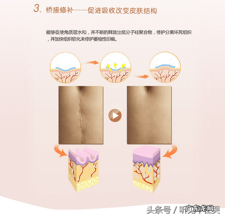 疤痕增生刚开始出现怎么消除 疤痕如何消除