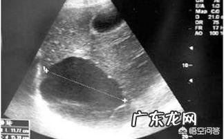 肝囊肿都有哪些症状?