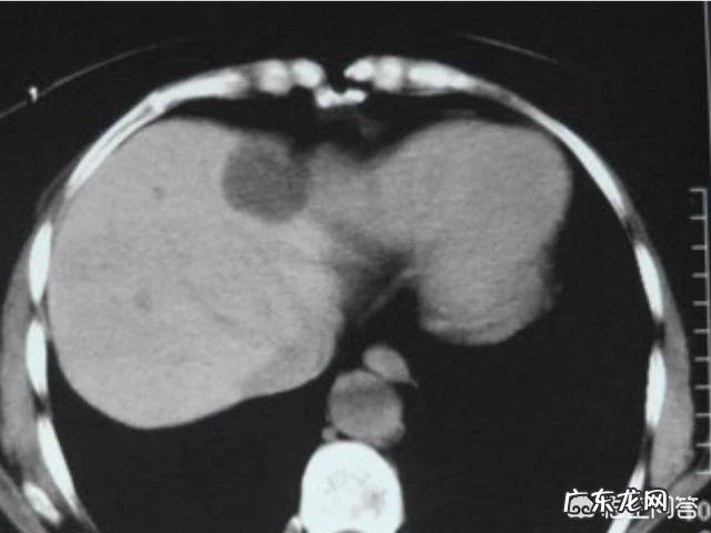 肝囊肿都有哪些症状?