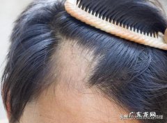 现在脱发的人多吗？有什么好方法可以防止脱发？