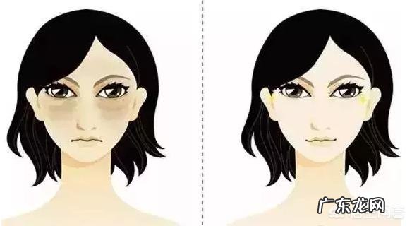 吸脂去眼袋多久才能恢复?