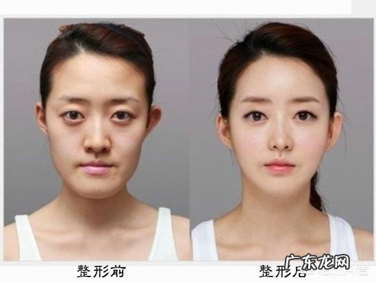 哪些方法可以去除皱纹呢?