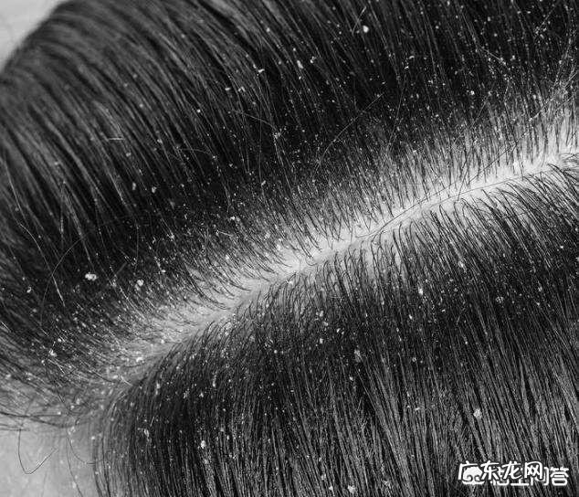 头皮屑怎么去除?