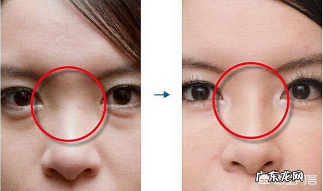 玻尿酸隆鼻可以维持多长时间?