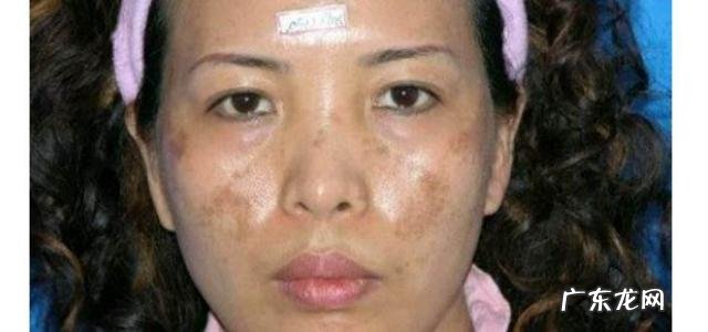 很多女性的斑看起来不一样,斑分几种?