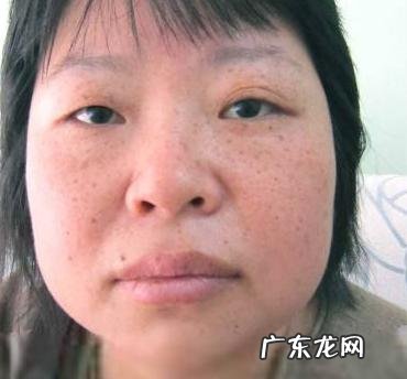 很多女性的斑看起来不一样，斑分几种？
