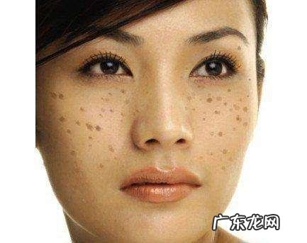 很多女性的斑看起来不一样,斑分几种?