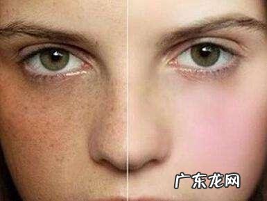 很多女性的斑看起来不一样,斑分几种?