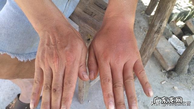 被马蜂蜇了怎么办?