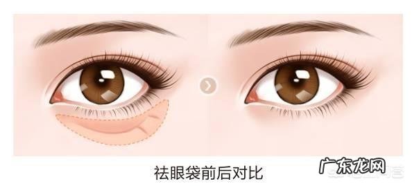 眼袋严重下垂,用什么方法能解决?