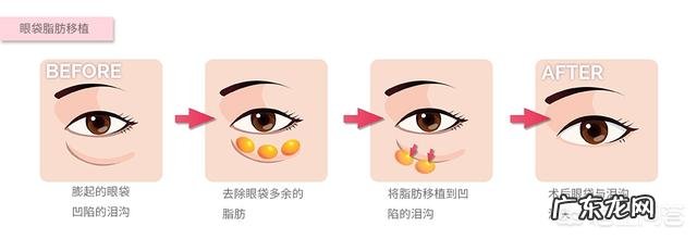 眼袋严重下垂,用什么方法能解决?